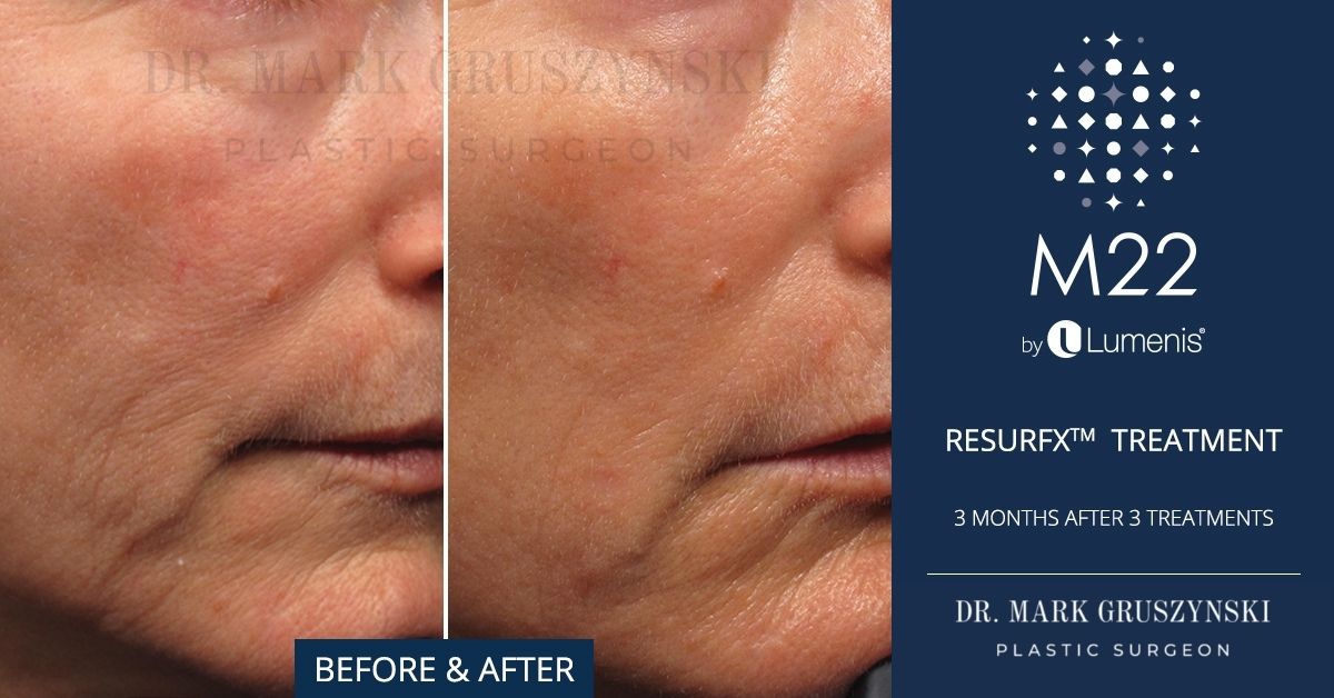 Laser Treatments With Lumenis Stellar M22 | Dr. Mark Plastic Surgery