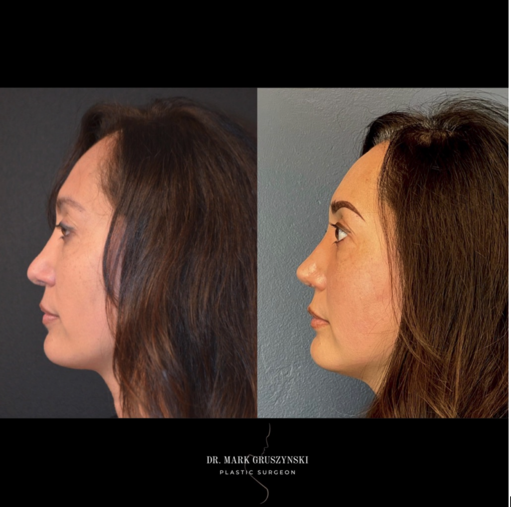 What is revision rhinoplasty?