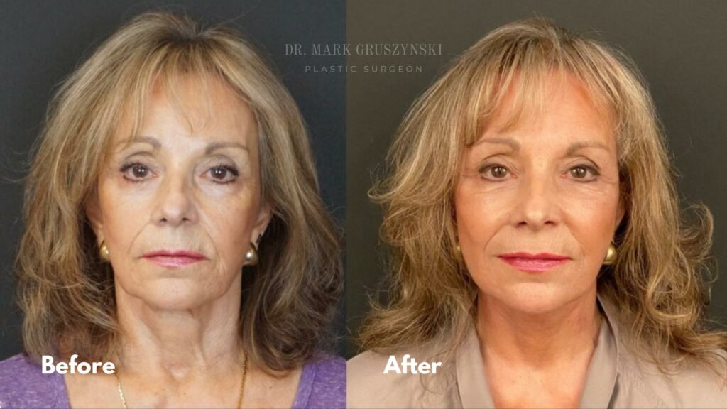 Dr. Mark Plastic Surgery Facelift Before & After (1)