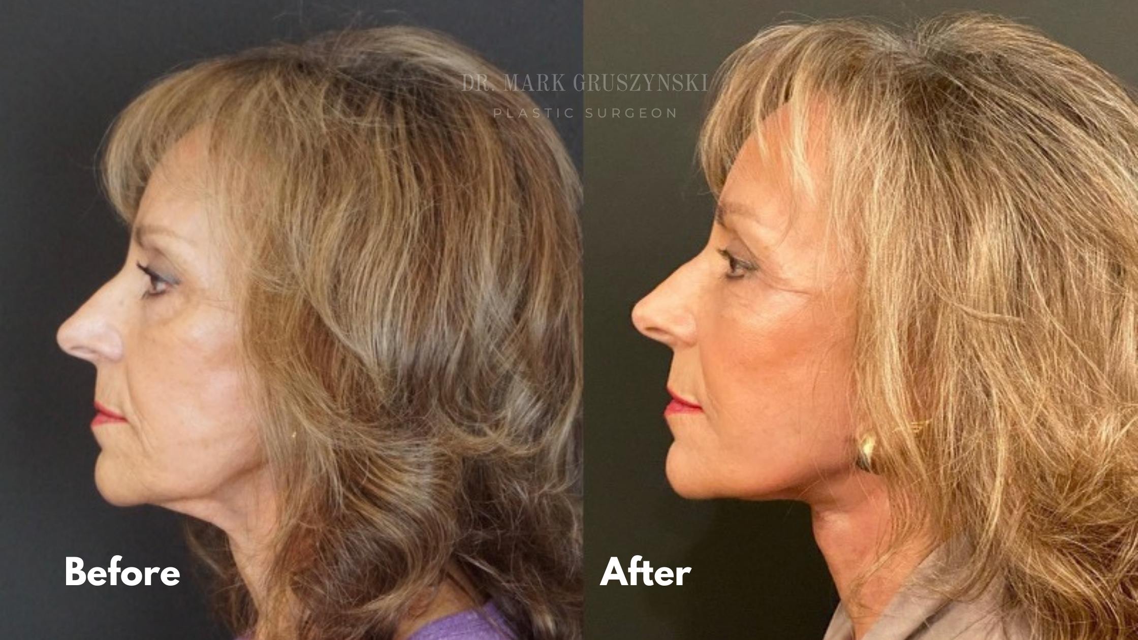 Dr. Mark Plastic Surgery Facelift Before & After (2)