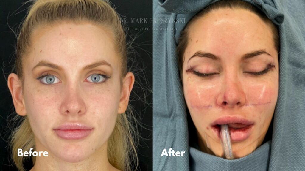 Dr. Mark Plastic Surgery MidFace lift & Fox Eye Surgery Before & After