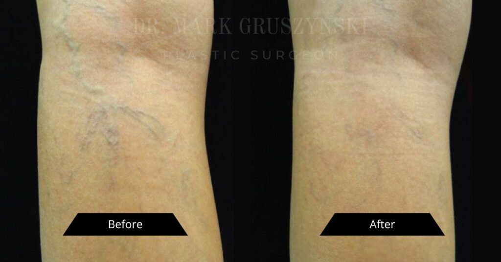 Spider Vein Treatment Before and After in Scottsdale, AZ