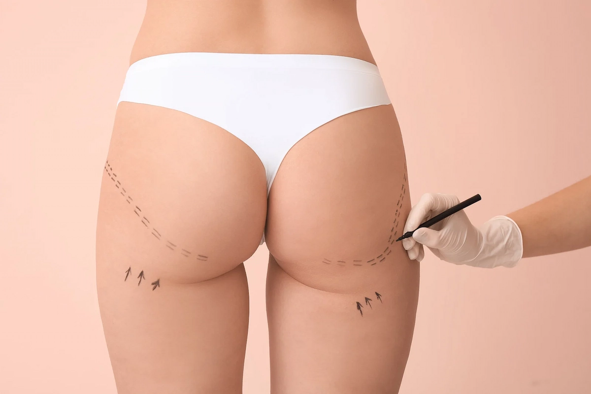Brazilian Butt Lift Dr. Mark Plastic Surgery
