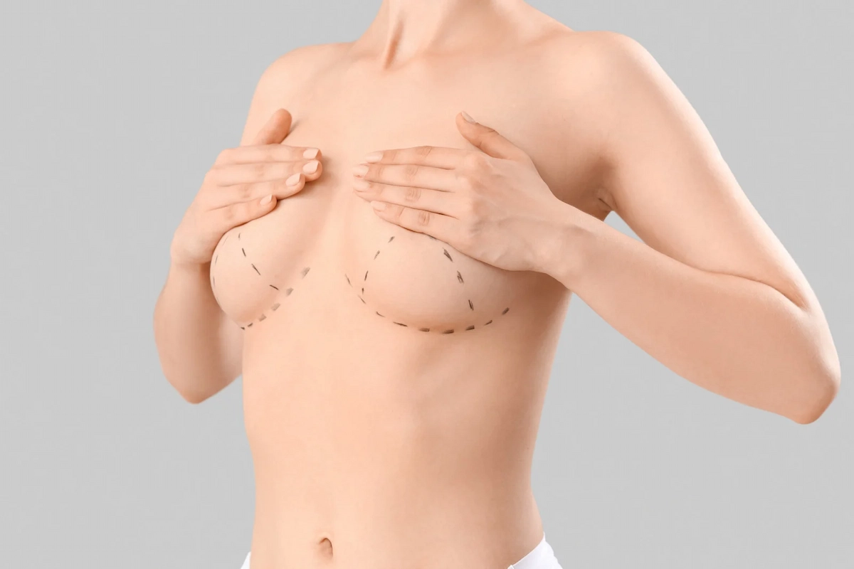 Breast Augmentation Surgery Markings
