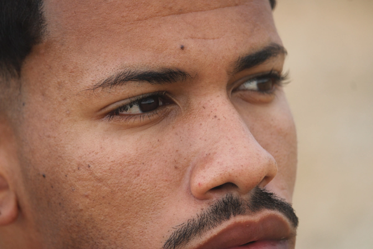 Male Nose Job Patient