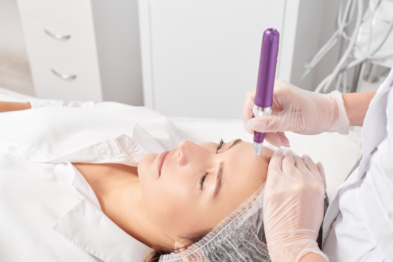 Phoenix Microneedling