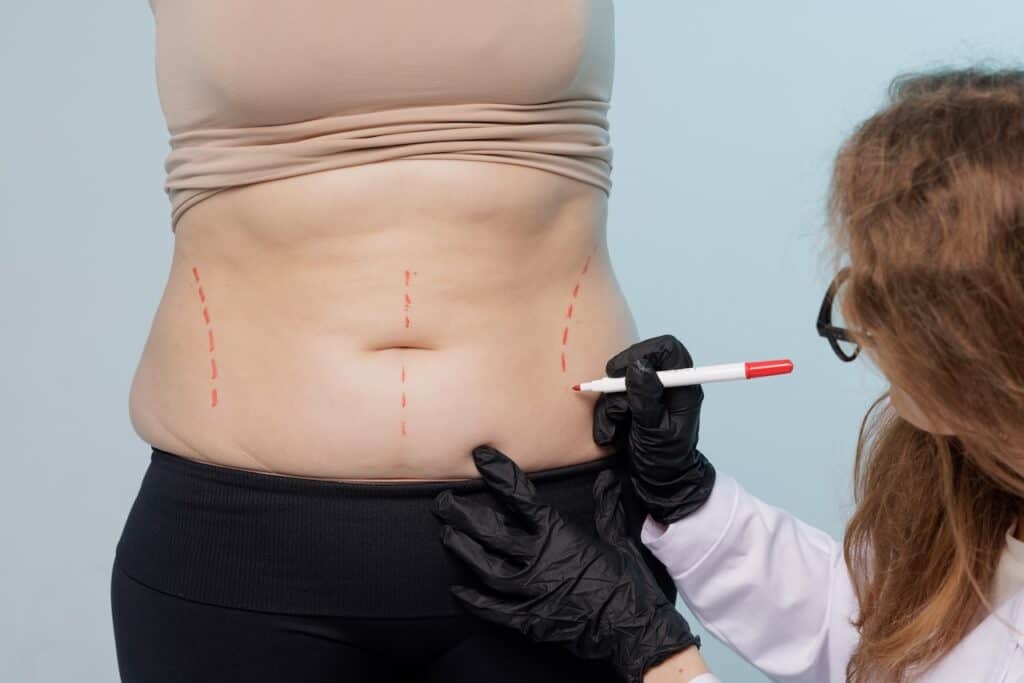 Reverse Tummy Tuck Surgery