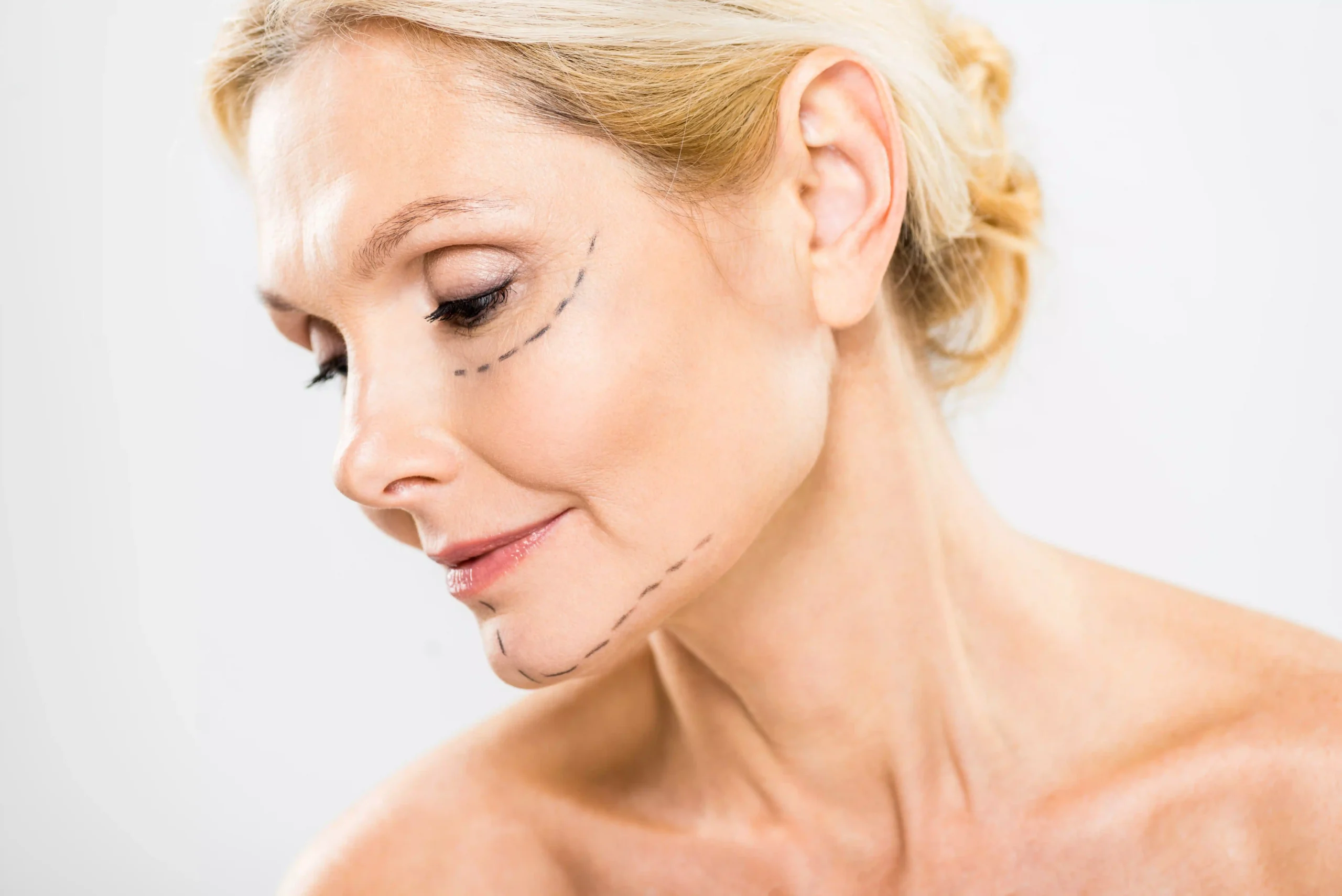 Traditional Facelift Patient Scottsdale