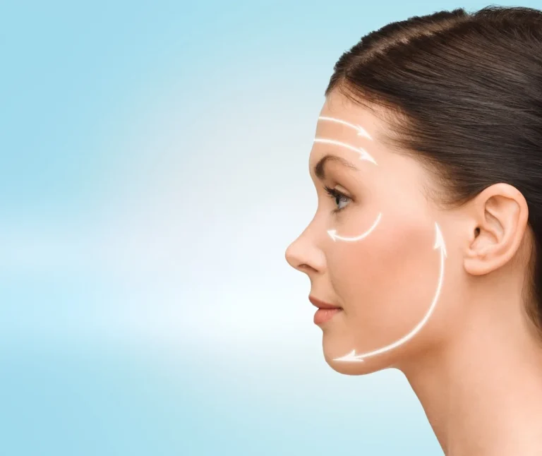 Woman recovering after facelift surgery