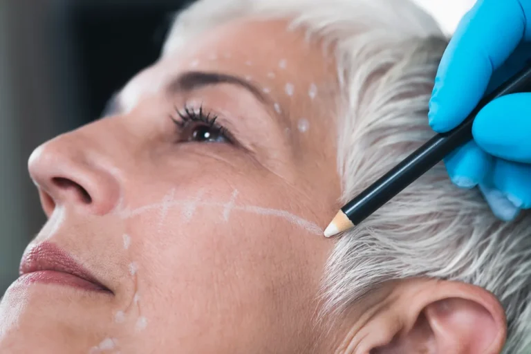 Woman prepped up for facelift surgery