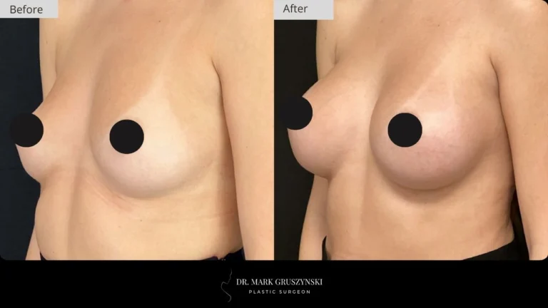 Dr Mark Plastic Surgery Breast Augmentation Patient 2a