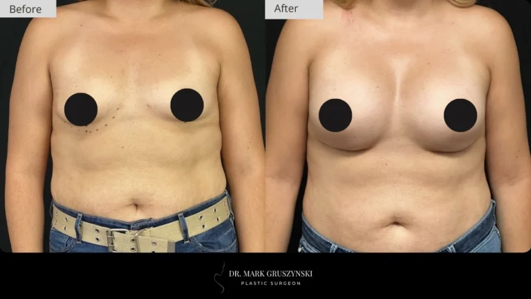 Dr Mark Plastic Surgery Breast Augmentation Patient 3a