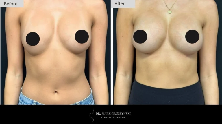 Dr Mark Plastic Surgery Breast Augmentation Patient 4a