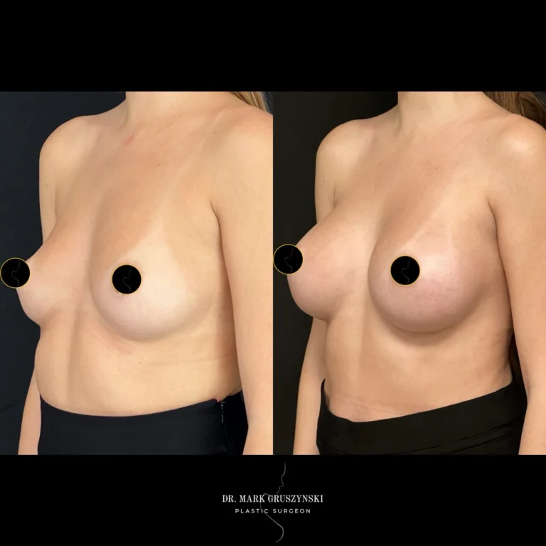 Dr Mark Plastic Surgery Breast Augmentation Patient 5a