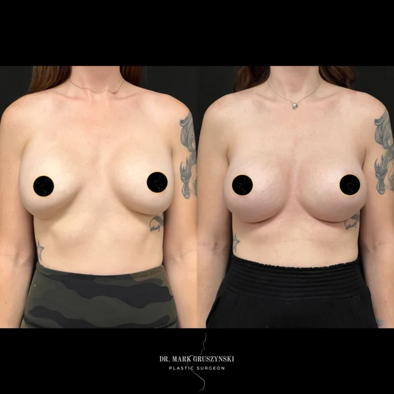 Dr Mark Plastic Surgery Breast Augmentation Patient 6a