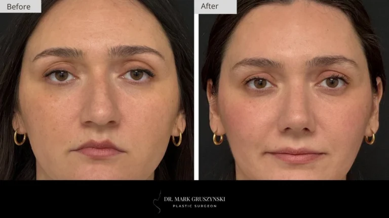 Dr Mark Plastic Surgery Rhinoplasty Patient 1a