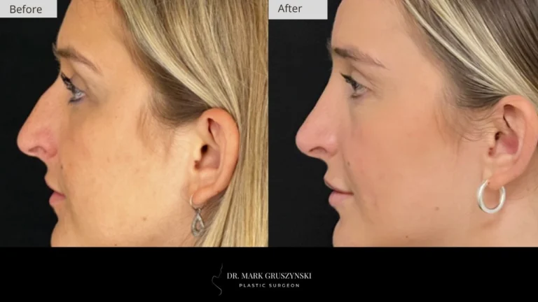 Dr Mark Plastic Surgery Rhinoplasty Patient 2a