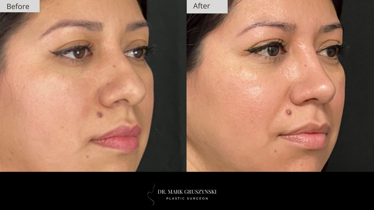 Dr Mark Plastic Surgery Rhinoplasty Patient 3b