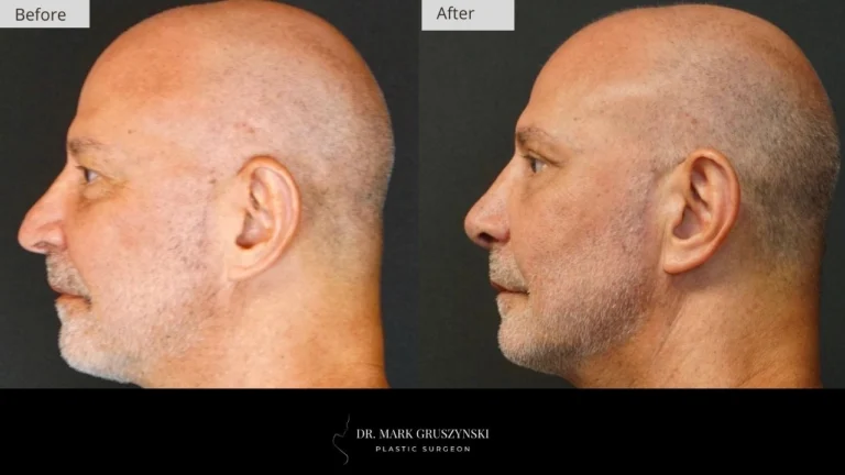 Dr Mark Plastic Surgery Rhinoplasty Patient 4a