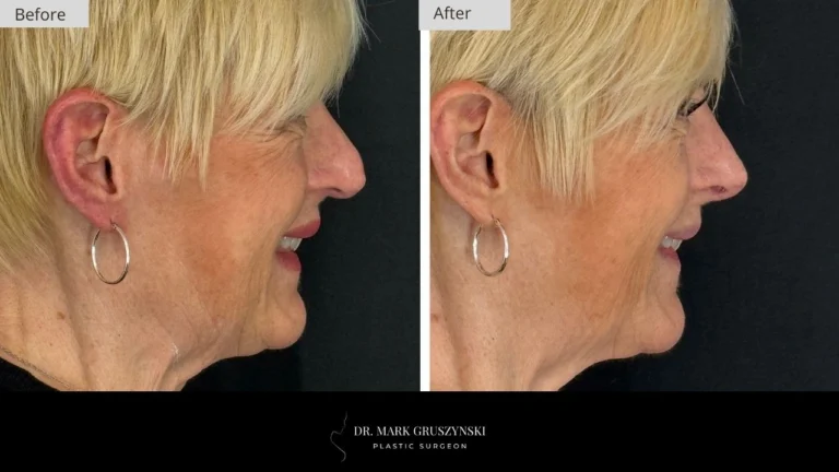 Dr Mark Plastic Surgery Rhinoplasty Patient 5a