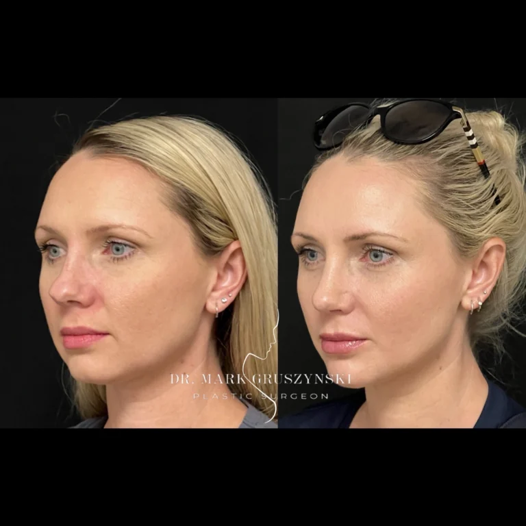 Dr Mark Plastic Surgery Rhinoplasty Patient 6a