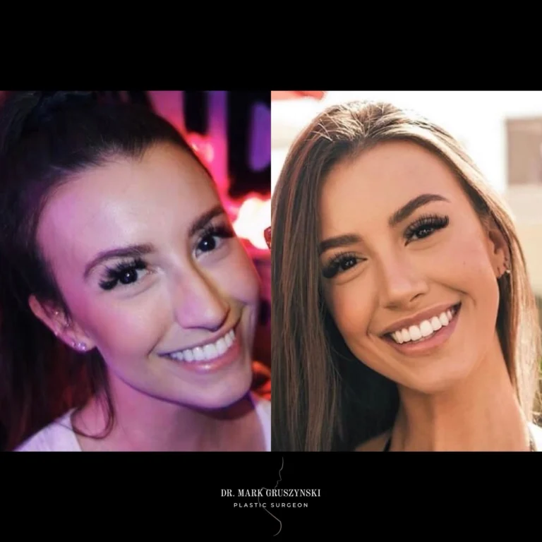 Dr Mark Plastic Surgery Rhinoplasty Patient 7a