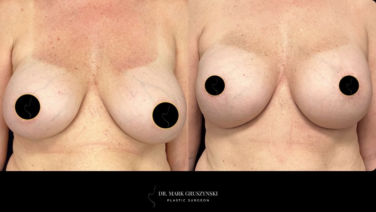 Dr Mark Plastic Surgery Implant Revision Patient 1a