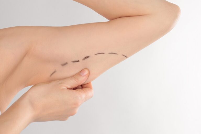woman with marks on her upper arm