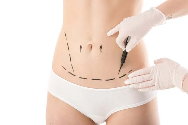 surgeon in latex white gloves marking the abdomen of woman
