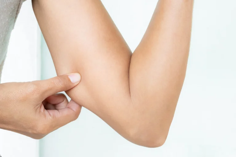 fat on woman's upper arm