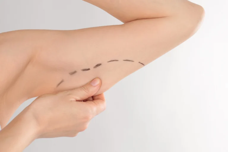 woman with marks on her upper arm