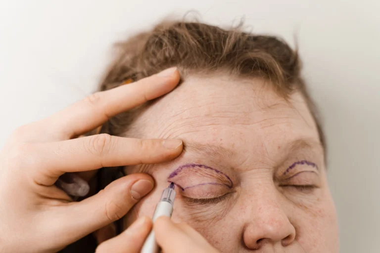 eyelid surgery mark up pre op