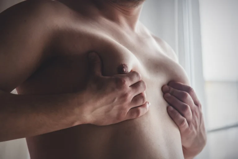 young man with gynecomastia