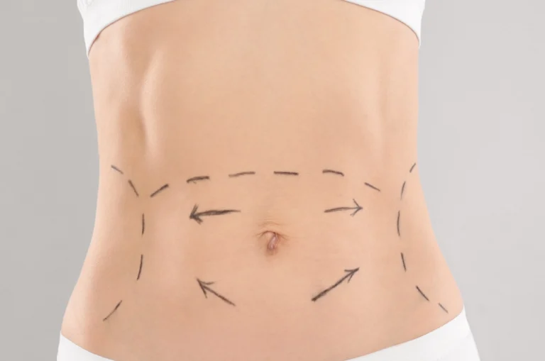 woman's abdomen marked with arrows before procedure