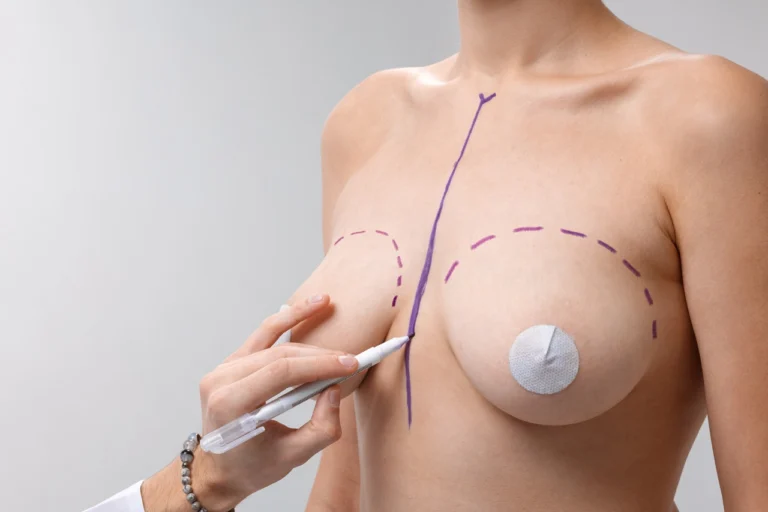 drawing pre-operative marks on woman's breasts