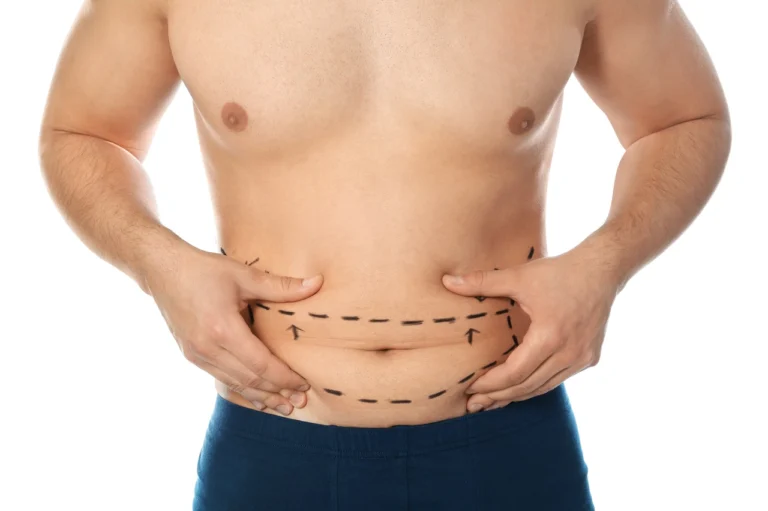 man's torso marked for plastic surgery